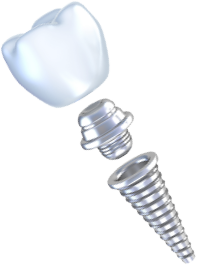 インプラントとは？