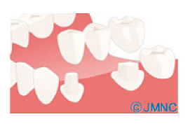 健康な歯を削りたくない