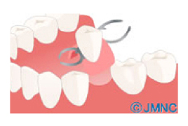 入れ歯がしっくりこない