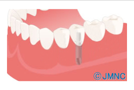 健康な歯を削りたくない