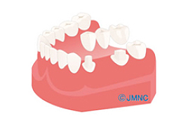 ブリッジの場合