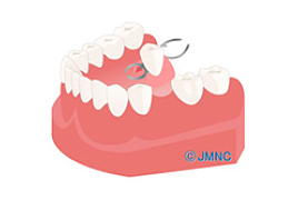 入れ歯の場合