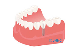 インプラントなら