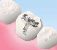 銀歯(保険適用)